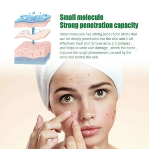 Acne Facial Serum Pore Shrinking Skin Care Pimple Spots Remover