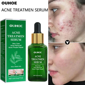 Acne Facial Serum Pore Shrinking Skin Care Pimple Spots Remover