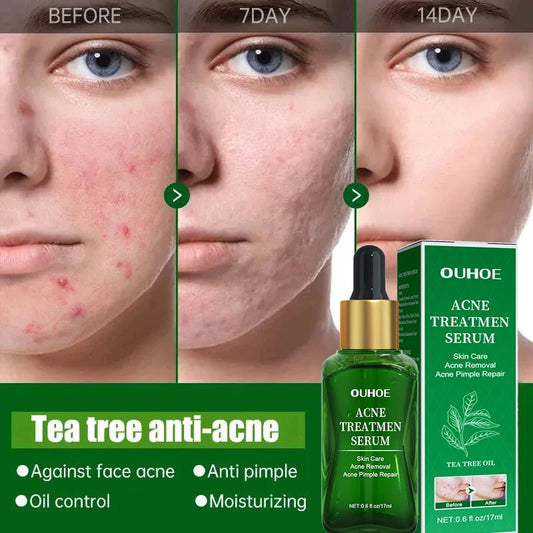 Acne Facial Serum Pore Shrinking Skin Care Pimple Spots Remover